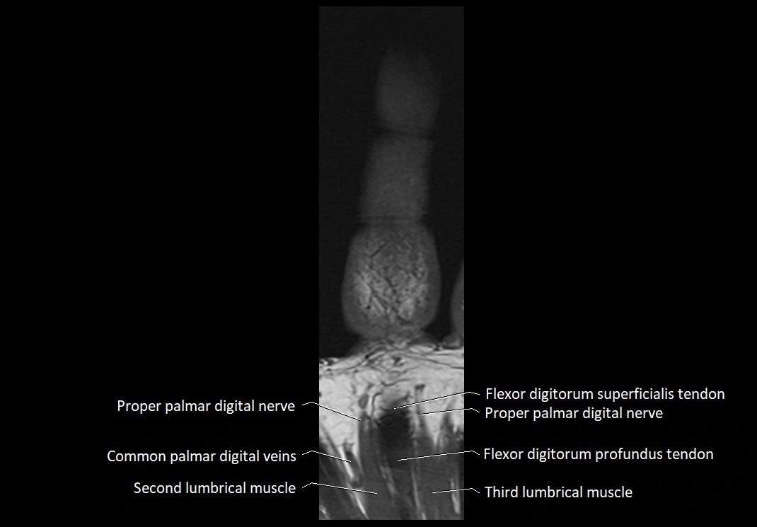 Finger anatomy coronal cross section 3TMRI labelled  image 10.webp
